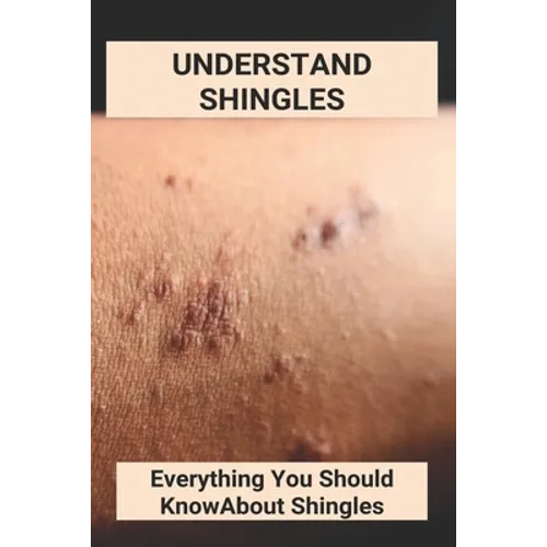 Understand Shingles: Everything You Should Know About Shingles: Shingles Topical Treatment