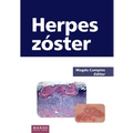 Herpes zóster