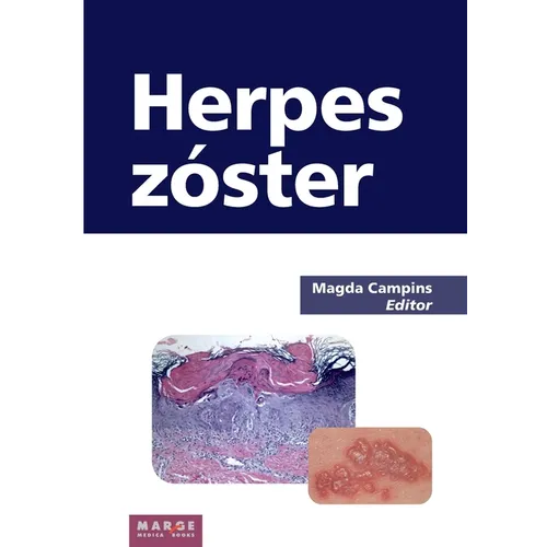 Herpes zóster