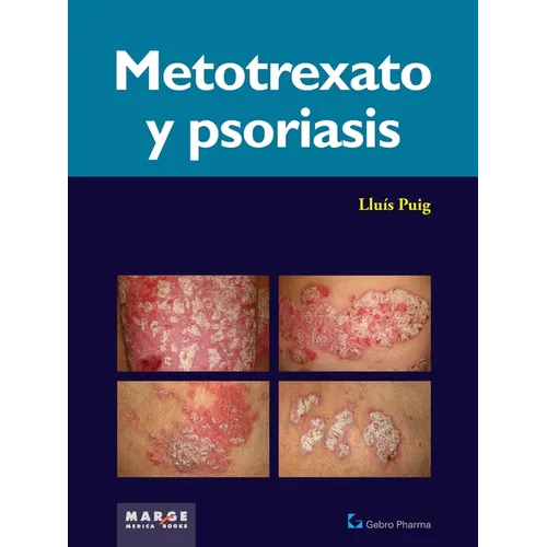 Metotrexato y psoriaris
