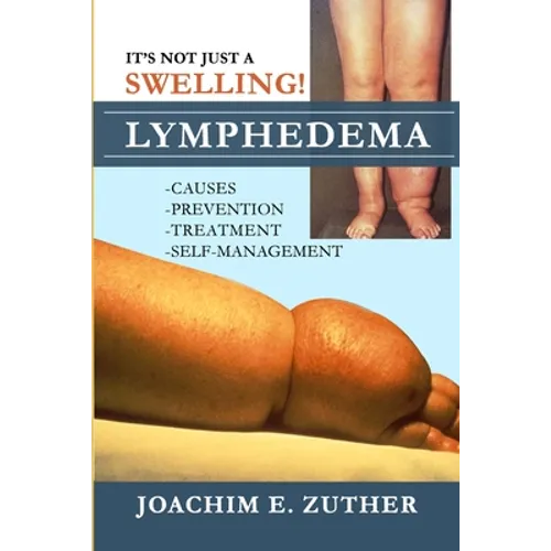 It's Not Just a Swelling! Lymphedema: Causes, Prevention, Treatment, Self-Management