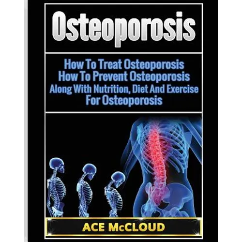 Osteoporosis: How To Treat Osteoporosis: How To Prevent Osteoporosis: Along With Nutrition, Diet And Exercise For Osteoporosis